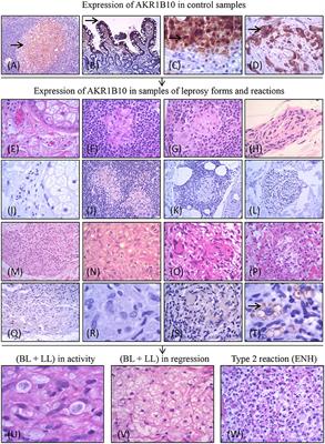 Potential of AKR1B10 as a Biomarker and Therapeutic Target in Type 2 Leprosy Reaction